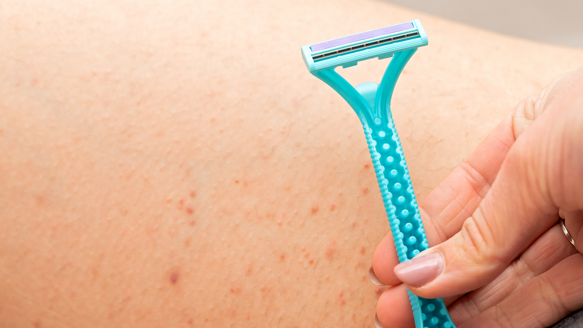 Røde knopper fra barbering