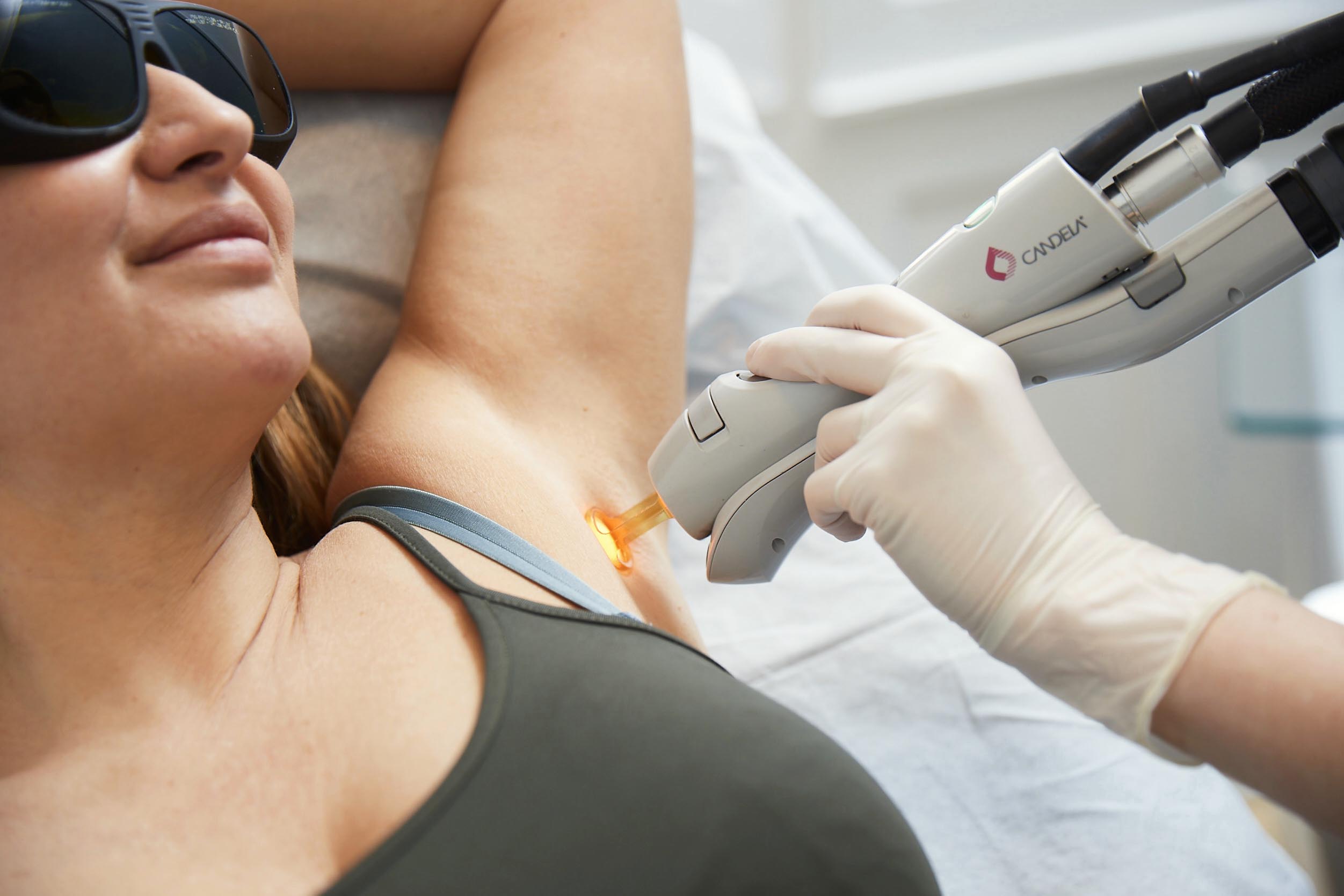 Candela laser nærbillede