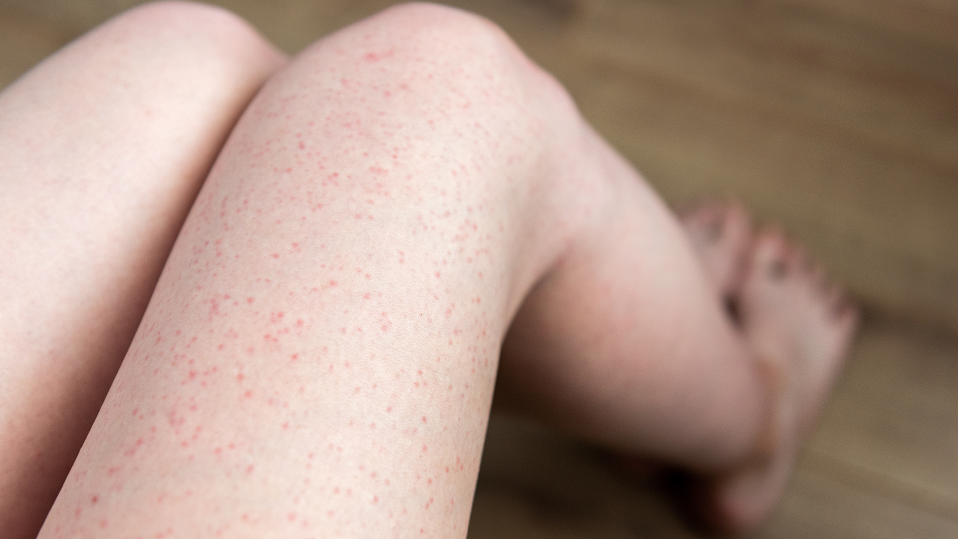 Indgroede hår og røde knopper